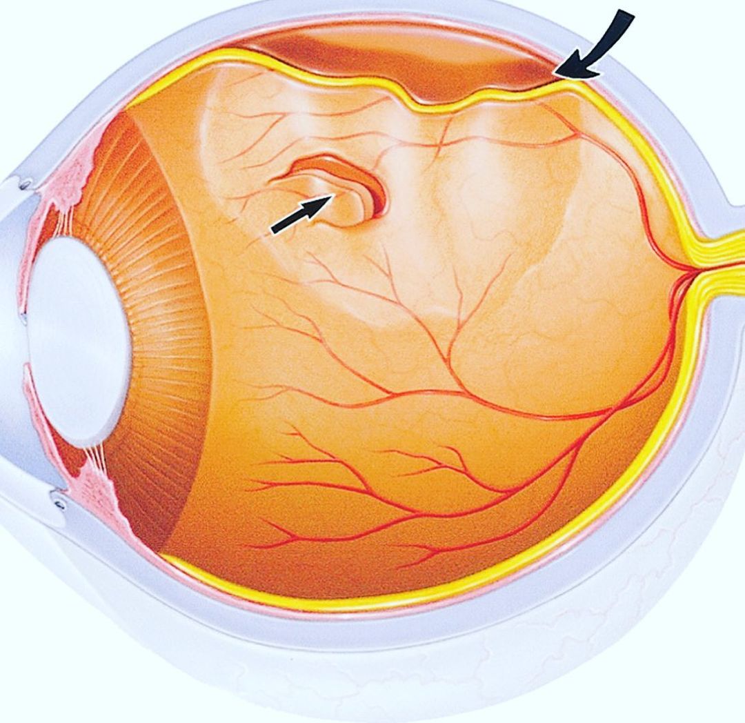Стекловидное тело операция. Отслойка сетчатки глазное дно. Экссудативная отслойка сетчатки. Тракционная отслойка сетчатки глаза.
